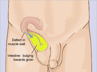 Hernia Repair Picture of Hernia Repair
